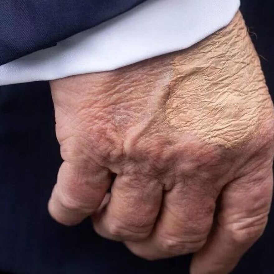 Close-up of a hand showing skin texture and bizarre marks on Trump’s body under natural light.