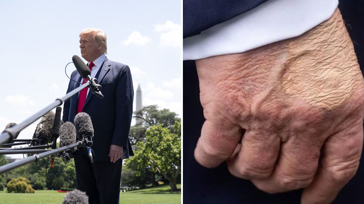 Donald Trump speaking outdoors beside close-up of hand showing bizarre marks on body revealed by experts.