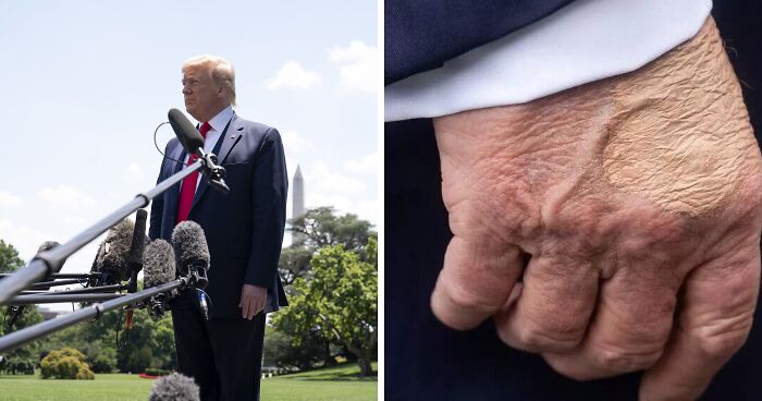 Experts Reveal What Bizarre Marks On Trump’s Body Could Actually Be
