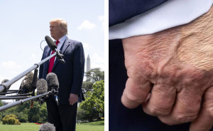 Experts Reveal What Bizarre Marks On Trump’s Body Could Actually Be