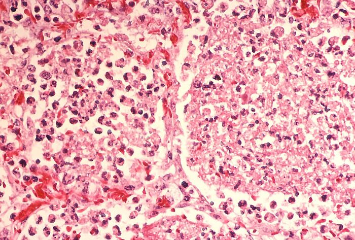 Microscopic view of lung tissue showing infection cells linked to Legionnaires disease outbreak in New York City. Microscopic view of lung tissue showing infection cells linked to Legionnaires disease outbreak in New York City.